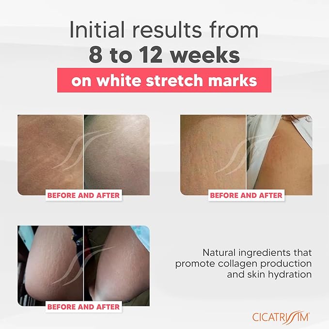 Cicatrissim White Stretch Mark Cream for White and Old Striae - Softens Stretch Marks, Evens Skin Tone, and Firms Skin - All Skin Types - 150g