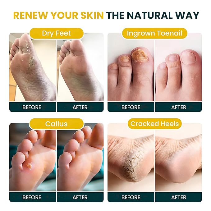 FOOT CURE Citrus Detox Foot Soak with Epsom Salts – for Foot Callus, Damaged Toenail Appearance, Pedicure Spa, and Soothing Sore, Tired Feet - 16 oz (Pack of 1)