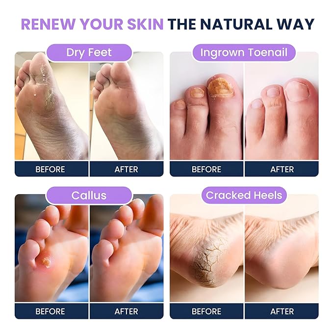 FOOT CURE Soothing Lavender Foot Soak - Pedicure Foot Spa with Epson Salts for Soaking Feet - Foot Massager Spa - Foot Scrubber Dead Skin Remover - Epsom Salt Bath Soak (Pack of 2)